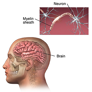 Side view of brain in head. Inset shows normal neurons.