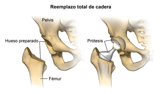 Reemplazo total de cadera