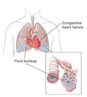 Fluid buildup in the lower part of the lungs and alveoli as a result of congestive heart failture.