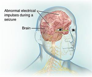 Side view of head showing brain with abnormal electrical impulses.