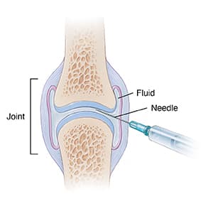 Needle inserted into space inside joint, drawing out fluid.