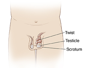 Male child's pelvic area showing testicular torsion.