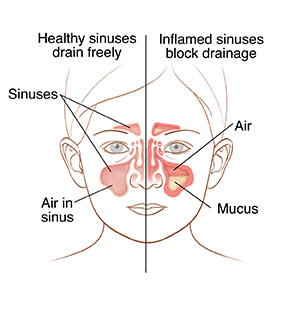 Front view of child’s face showing healthy sinuses on one side and inflamed sinuses on the other.